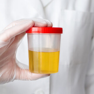 The doctor holds a can of urine analysis in his hand. Urine sample for exam. Selective focus.