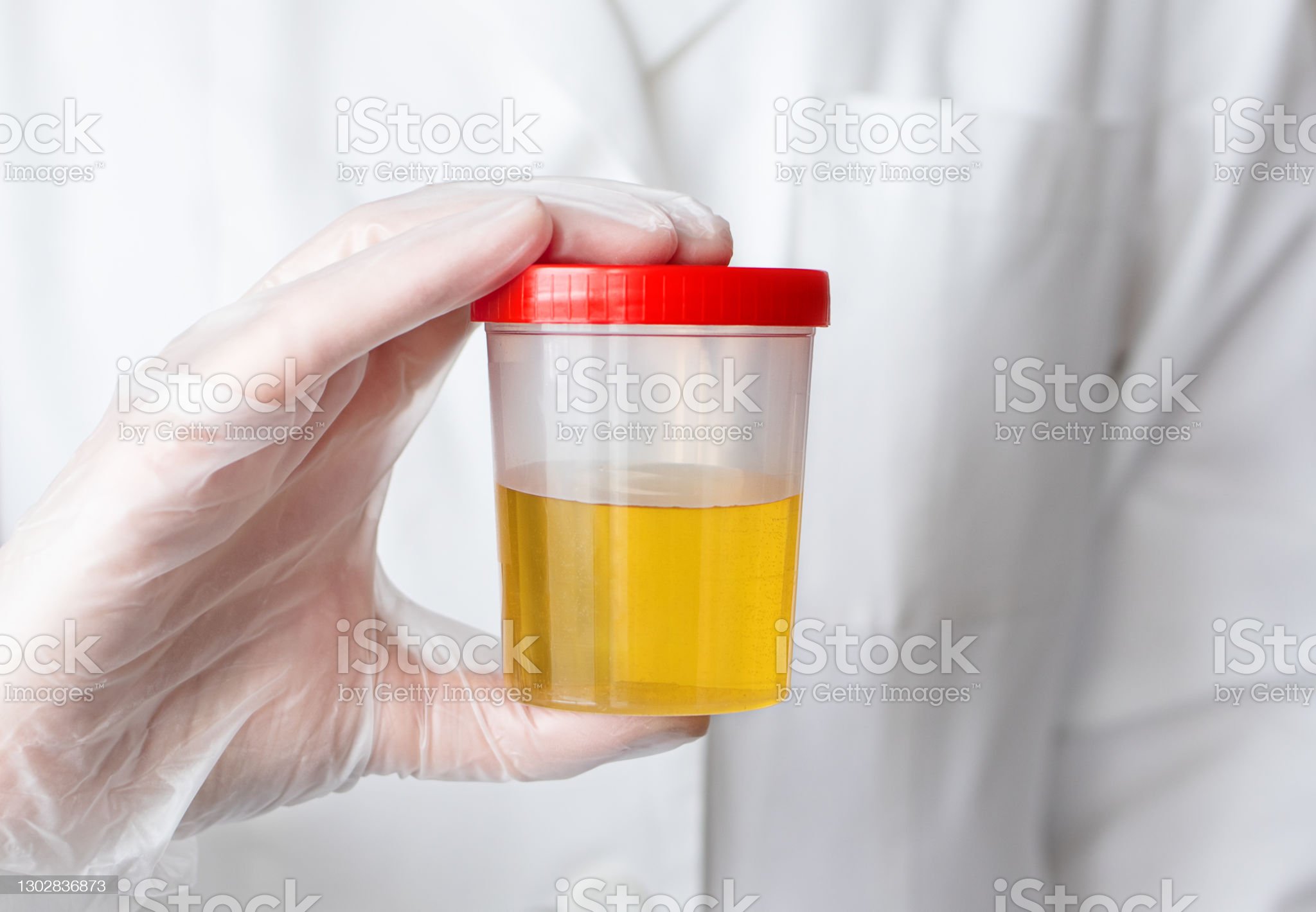 The doctor holds a can of urine analysis in his hand. Urine sample for exam. Selective focus.