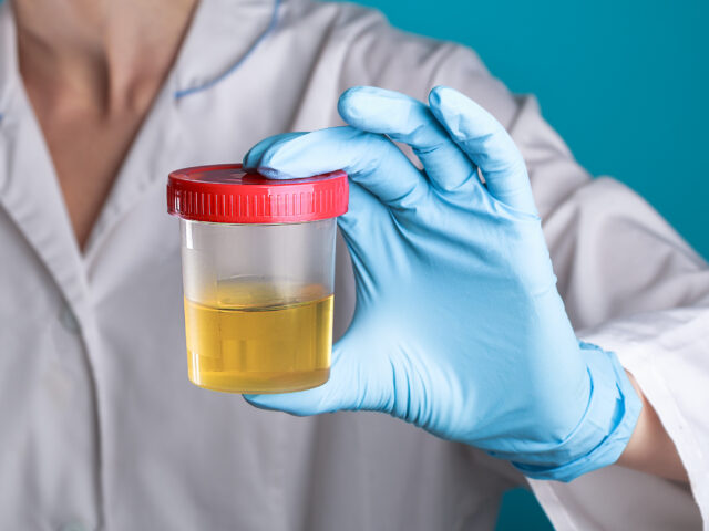 The Problem with Viewed Urine Collection—and How to Solve it with DNA Verification