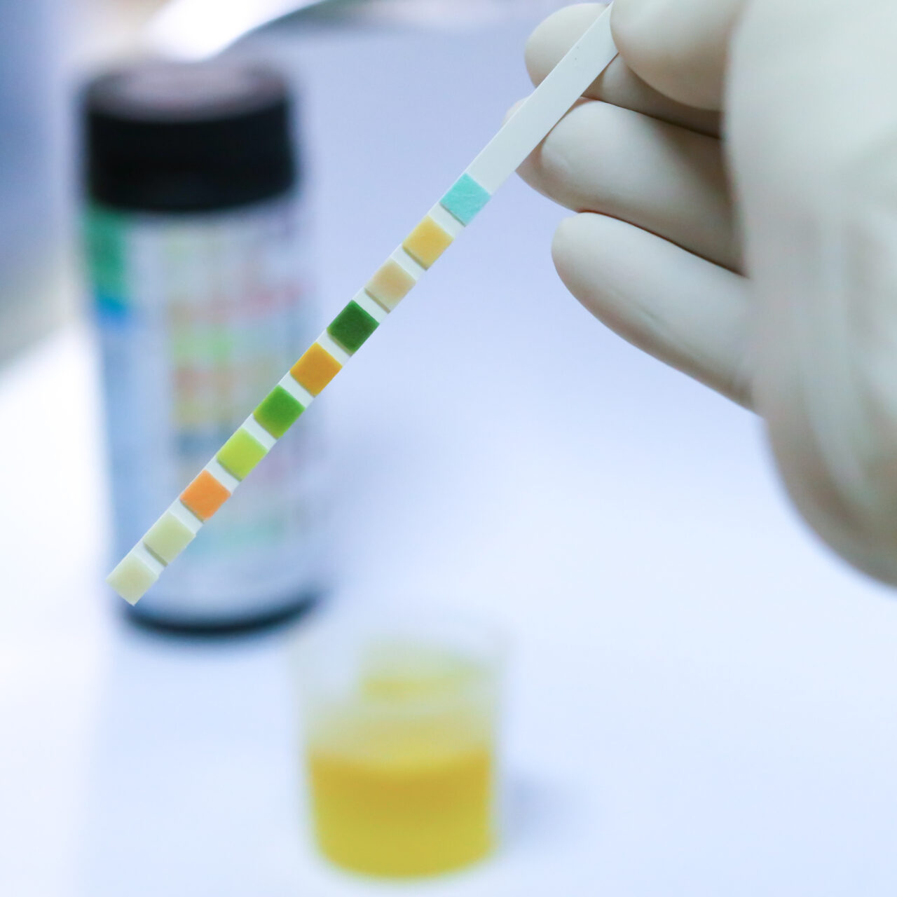 Reagent Strip for Urinalysis , Routine Urinalysis, check-up analysis in laboratory.